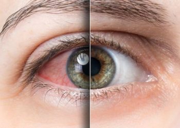 Global Dry Eye Syndrome Market Showing Strong Growth||Johnson & Johnson Services, Inc., Prestige Consumer Healthcare, Inc., Akorn, Inc., Sun Pharmaceutical Industries Ltd