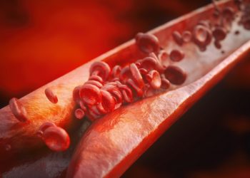 Low LDL Associated With Coronary Atherosclerosis Burden, CVD Risk in Non-Obese Patients With RA