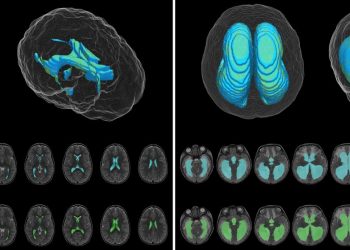 Automatic deep-learning AI tool measures volume of cerebral ventricles on MRIs in children
