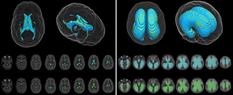 Automatic deep-learning AI tool measures volume of cerebral ventricles on MRIs in children