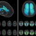 Automatic deep-learning AI tool measures volume of cerebral ventricles on MRIs in children