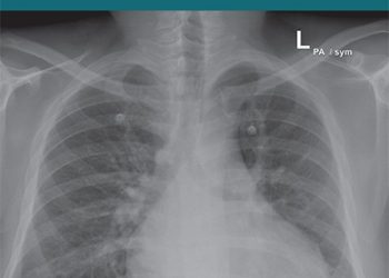 Hyoscine butylbromide versus acetaminophen for nonspecific colicky abdominal pain in children: a randomized controlled trial