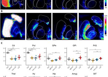 Mass spectrometry imaging identifies abnormally elevated brain l-DOPA levels and extrastriatal monoaminergic dysregulation in l-DOPA–induced dyskinesia