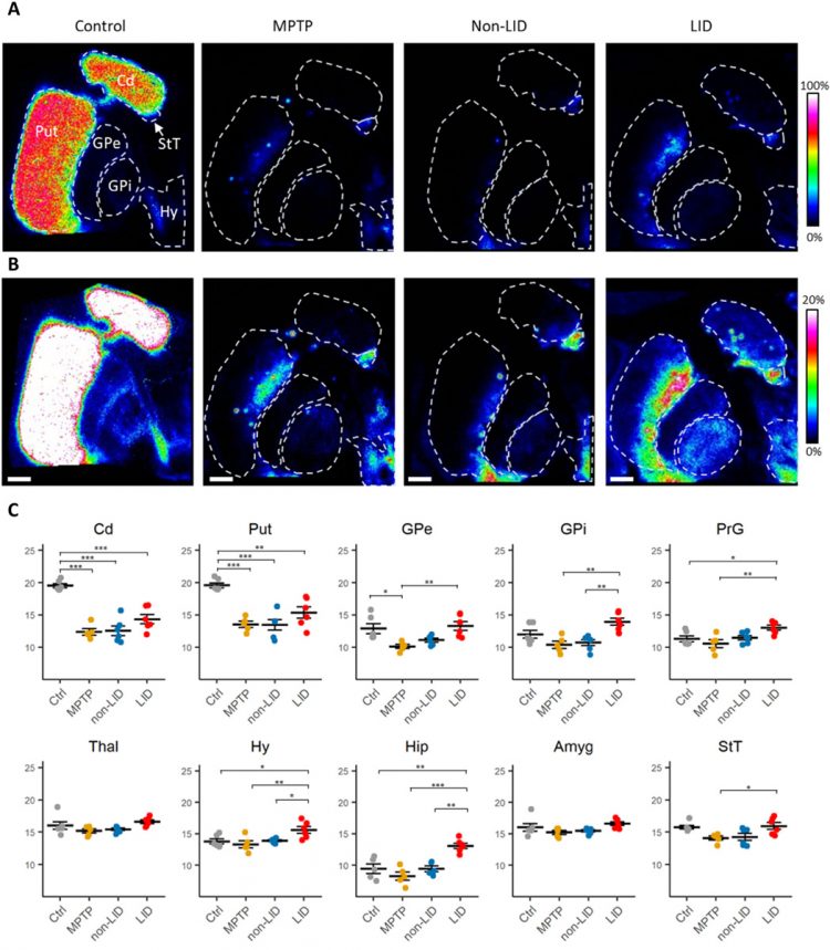 Mass spectrometry imaging identifies abnormally elevated brain l-DOPA levels and extrastriatal monoaminergic dysregulation in l-DOPA–induced dyskinesia