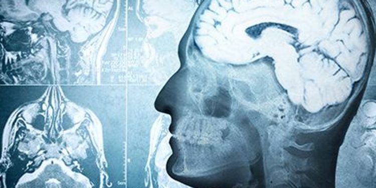 New Insights Into How COVID-19 Damages the Brain – Consumer Health News