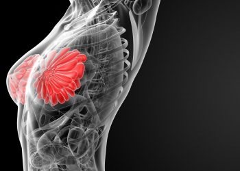 Low Breast Density Identified as Potential Prognostic Factor for Breast Cancer-Related Lymphedema Risk