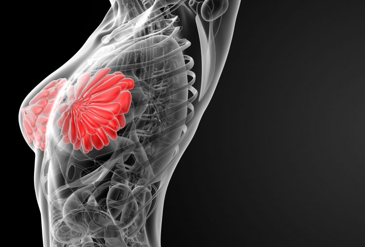 Low Breast Density Identified as Potential Prognostic Factor for Breast Cancer-Related Lymphedema Risk