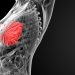 Low Breast Density Identified as Potential Prognostic Factor for Breast Cancer-Related Lymphedema Risk