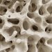 Risks After Denosumab Discontinuation Linked to Age and Prior Therapy