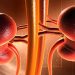 Transplant Beneficial for Kidney Failure in Sickle Cell – Consumer Health News