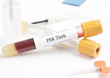 Metastatic Prostate Cancer Rates Rise as PSA Screening Decreases