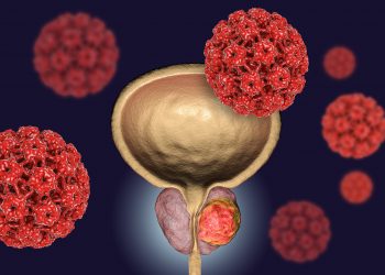 Experts Attribute Higher Incidence of Metastatic Prostate Cancer in the US to Fewer PSA Screenings