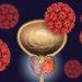 Experts Attribute Higher Incidence of Metastatic Prostate Cancer in the US to Fewer PSA Screenings