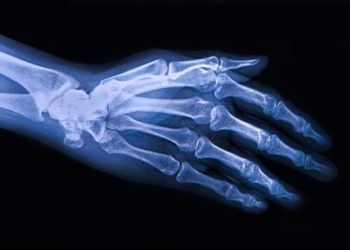 Kessler team receives funding to study factors leading to osteoarthritis after knee injury